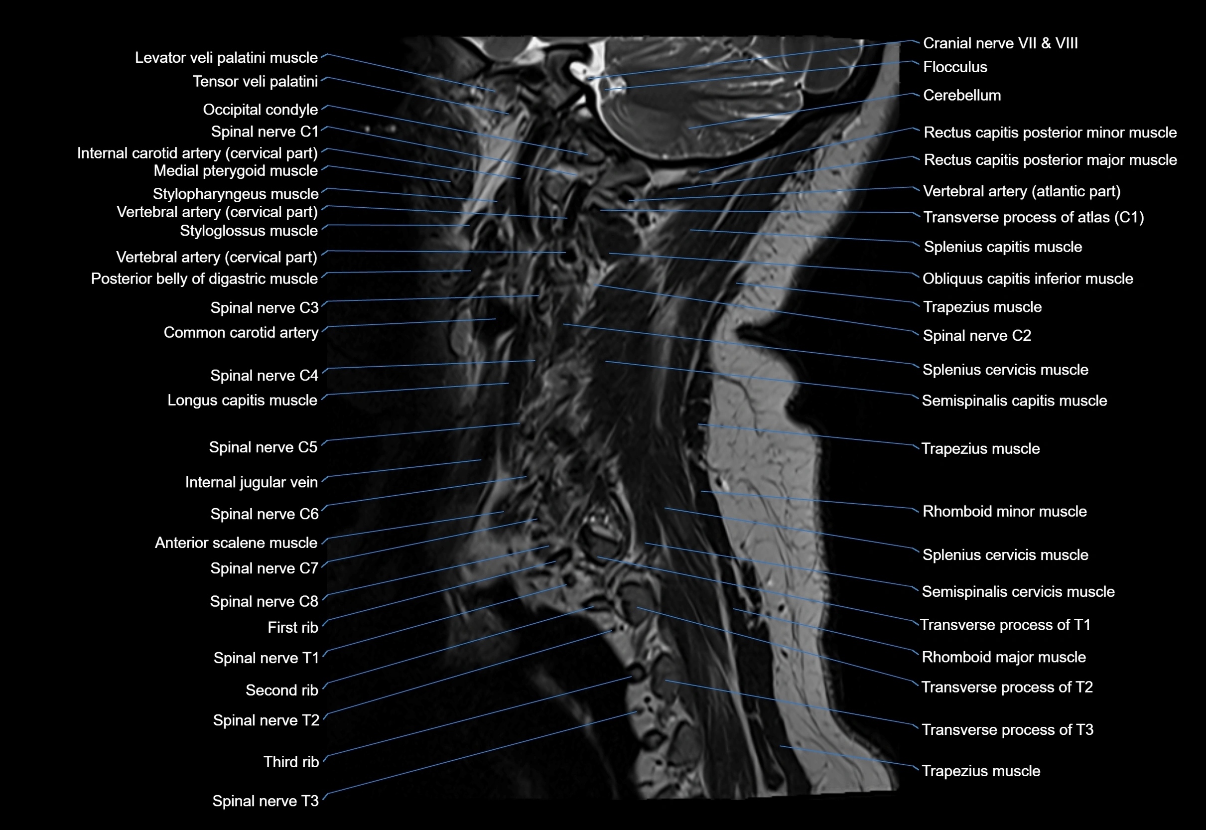 cervical spine cross sectional MRI anatomy 3T MRI  sagittal image-img-00001-00028.webp